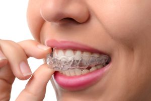 invisalign clear aligners