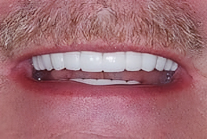 after treatment at our dental office in Plano, TX