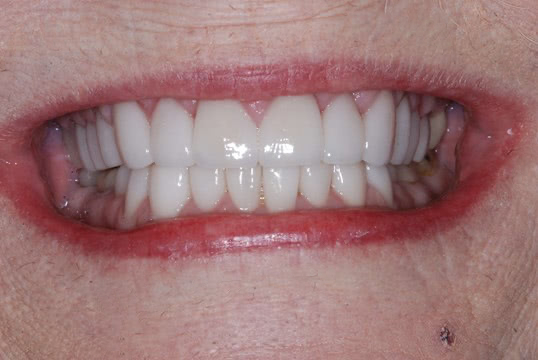 before treatment at our dental office in Plano, TX