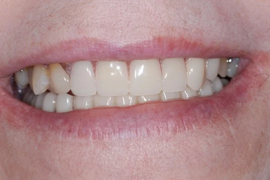 before treatment at our dental office in Plano, TX