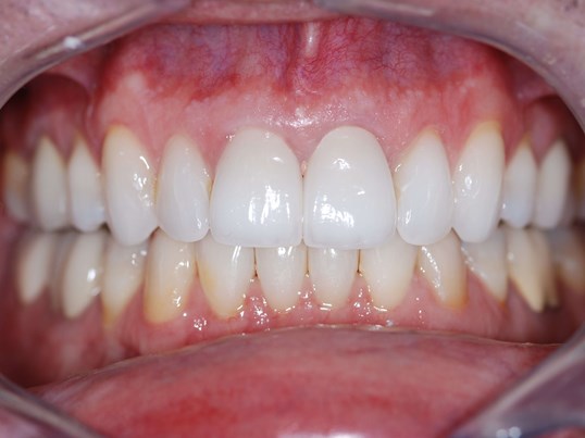 after treatment at our dental office in Plano, TX