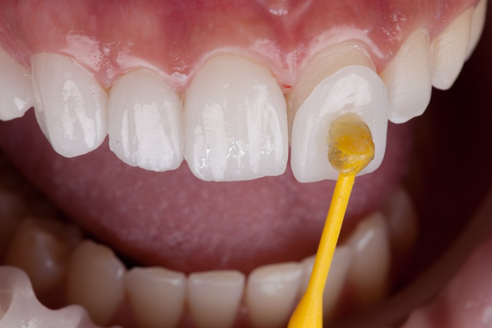 porcelain veneers at My Dentist in Plano