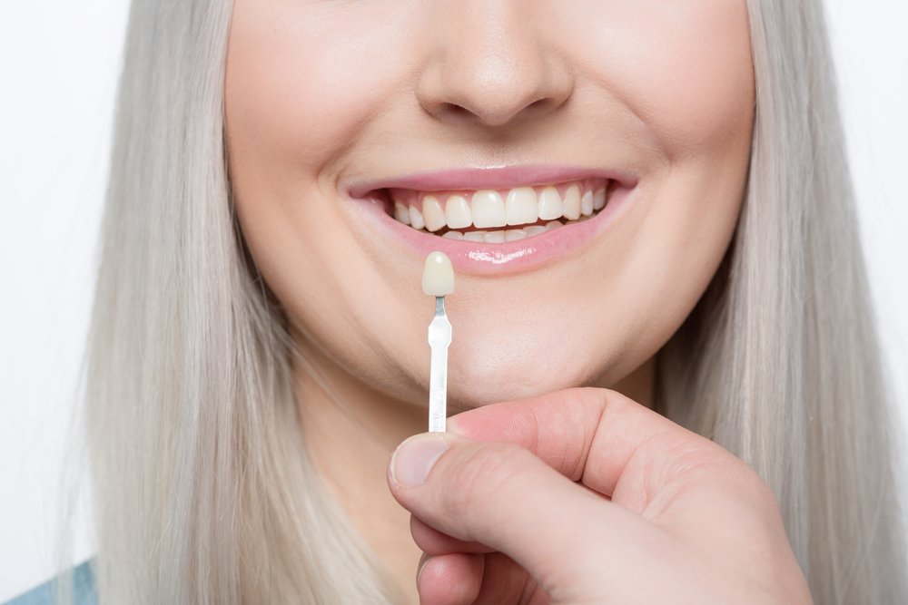 porcelain veneer shade check - cosmetic dentistry