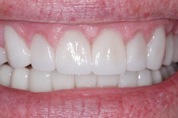 after cosmetic treatments at My Dentist in Plano