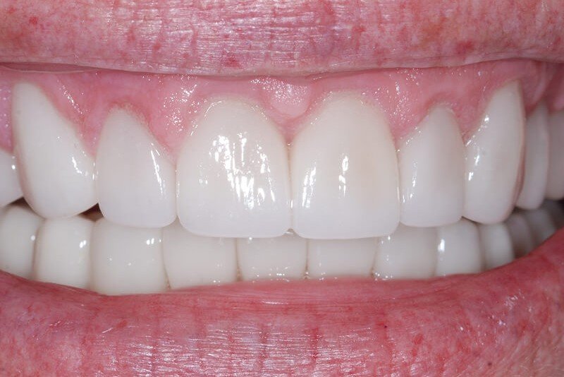 after cosmetic treatments at My Dentist in Plano