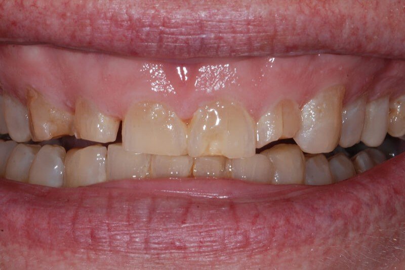 before cosmetic treatments at My Dentist in Plano